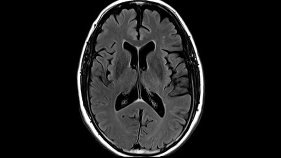 MRI of the brain against black background