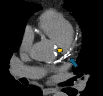 heart scan with blue and yellow arrow overlays