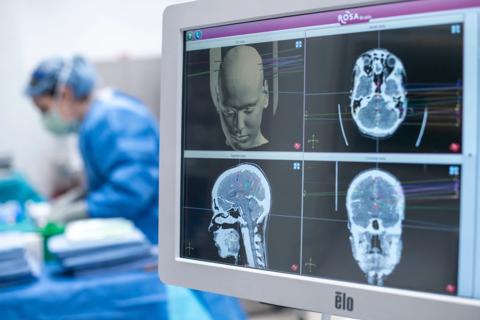 Epilepsy surgery