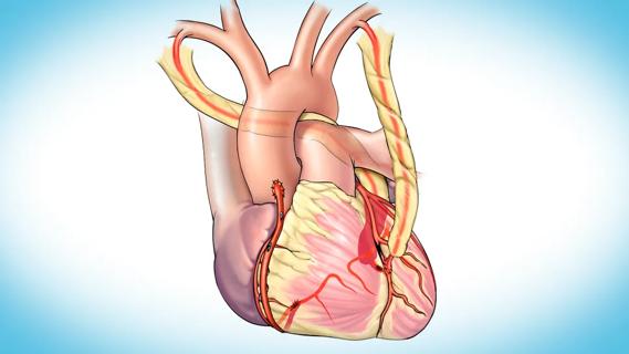 illustration of heart showing arterial grafts