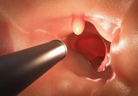Colonoscopy