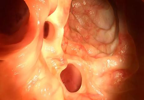 diverticulitis in the colon