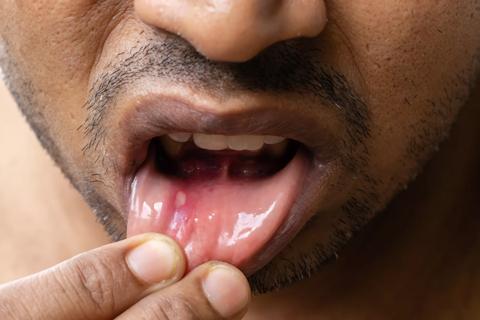 Person pulling bottom lip down to show mouth ulcer