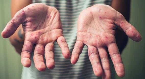 Adult palms of hands with symptoms of hand, foot and mouth disease