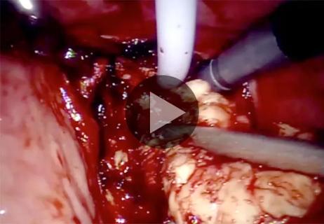 650&#215;450-Transvesical-Simple-Prostatectomy