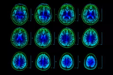 18-NEU-509-Nakamura-Volumetric-MRI-650&#215;450