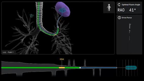 Robotic-Assisted Broncoscopy screenshot