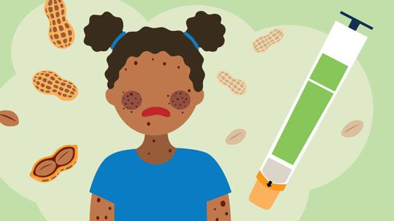 Child having allergic reaction, with peanuts and epinephrine pen nearby