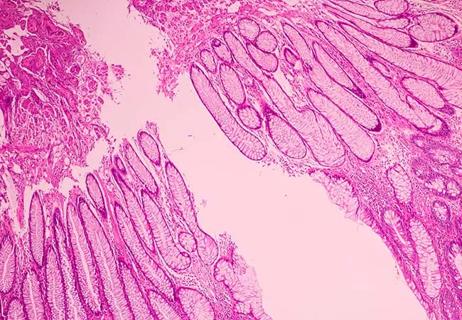 650&#215;450-Breast-Cancer