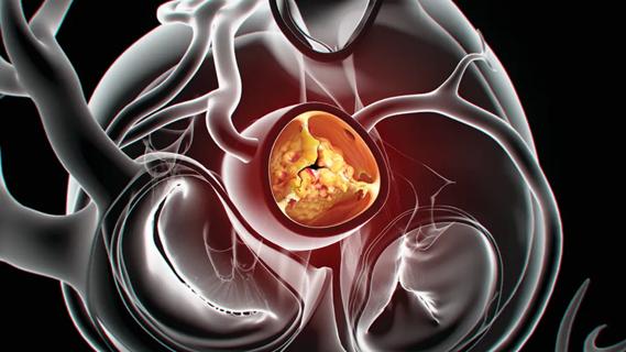 stenotic aortic valve within the larger human heart