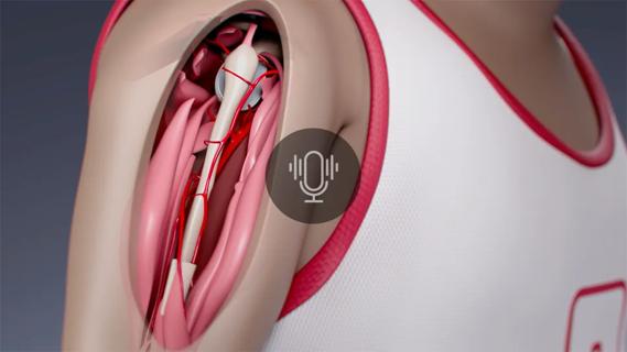 Illustration of osteosarcoma shoulder procedure