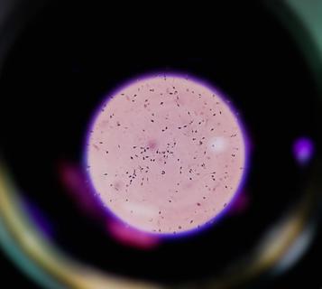 Sperm analysis on microscopic examination