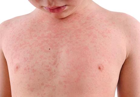 650&#215;450-Child-Allergy