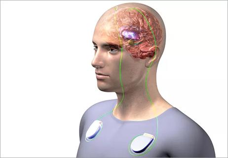 Deep Brain Stimulation for Neuropsych Disorders: Don’t Count It Out Yet