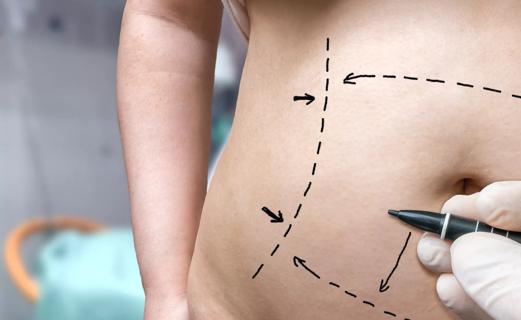 Tummy tuck