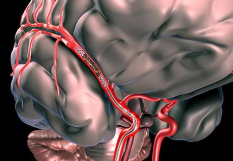 19-NEU-3868-endovascular-stroke-therapy_650x450