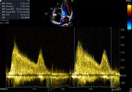 19-HRT-4025-Treadmill-Stress-Echo-CQD-Hero (002)