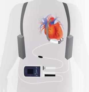 Left Ventricular Assist Device Therapy