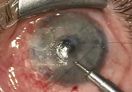 DSEK: An Unorthodox Approach that Benefits Patient with Perforated Cornea