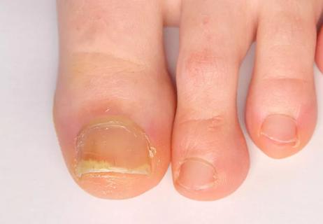 psoriatic arthritis affect on toenails