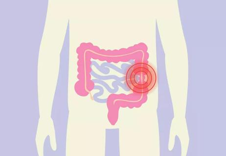 Illustration of the colon, large intesitine, small intestine and colon in the body with a pain icon above.