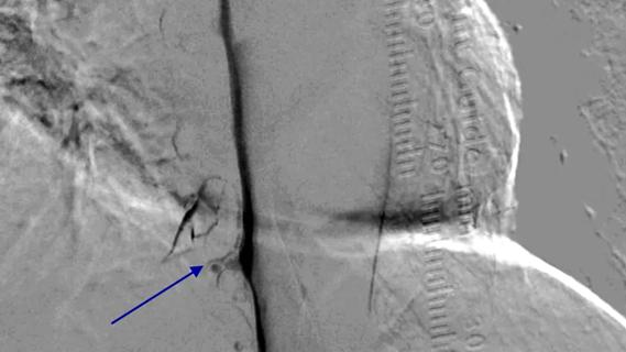 scan of brain anatomy with a blue arrow marking a point of interest