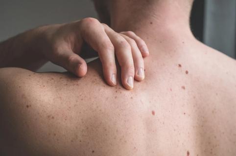 A person's back, covered in moles and freckles, with their hand reaching over their shoulder