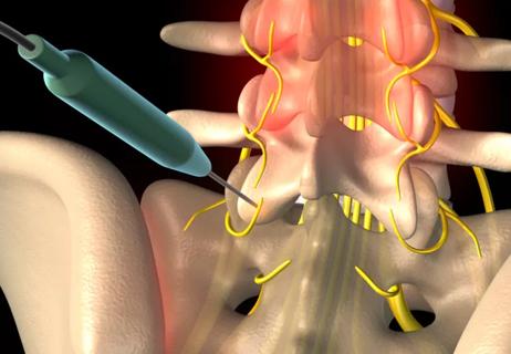 radiofrequency ablation for pain