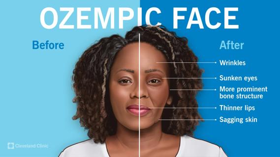 Ozempic face, before and after, with wrinkles, sunken eyes, thinner lips and sagging skin