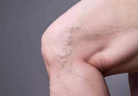 Varicose veins surrounding a bent knee shot in profile