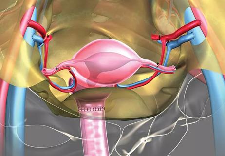 16-OBG2467-UterineTransplant-650&#215;450