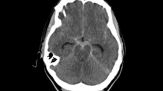 brain scan showing perimesencephalic subarachnoid hemorrhage