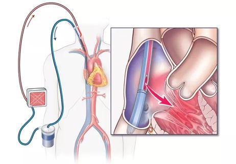 20-HVI-1885884-VV-ECMO_650x450