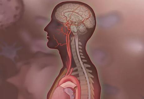 illustration showing effects of postural orthostatic tachycardia syndrome in human body