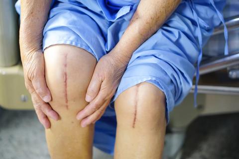 Should You Have Both Knees Replaced at the Same Time?