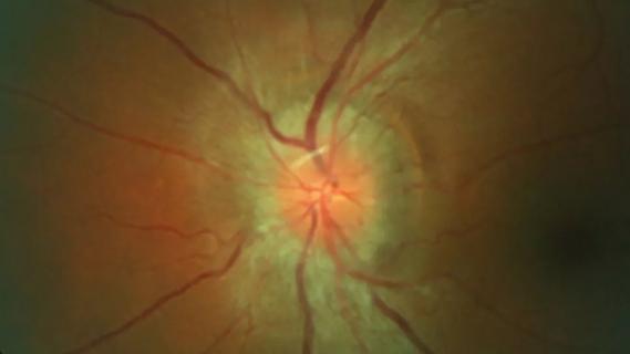 Fundus photography showing optic disc edema