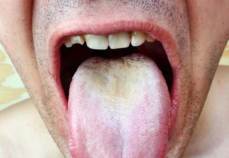 Thrush on tongue in man's mouth