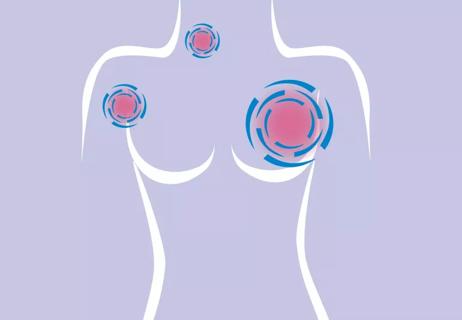 breast cancer spreading