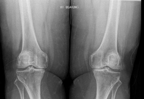 Knee osteoarthritis in a patient with obesity