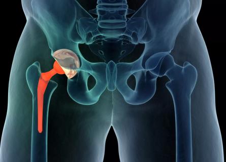 Hip replacement