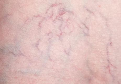 When Should I Worry About Varicose Veins?