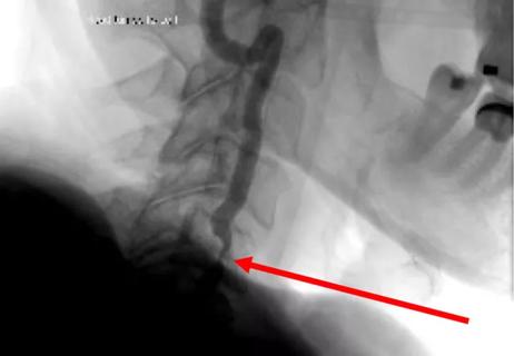 20-NEU-1875736_vertebral-artery-stenosis_650x450