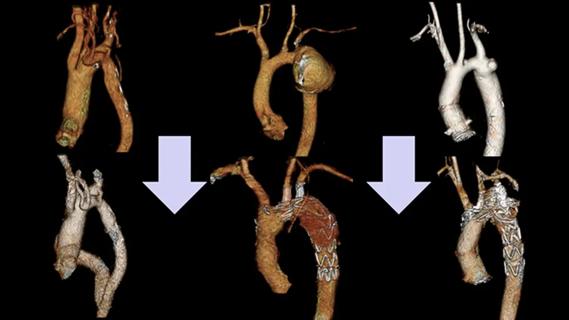 3D images of the aorta with downward-pointing arrows between them