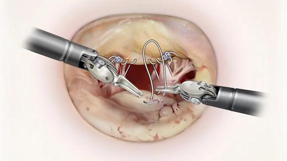 illustration of two robot arms suturing a heart valve