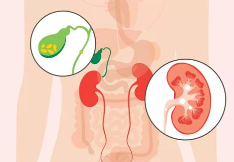 Illustration of the human body with closeups of the gallbladder and kidney with stones.