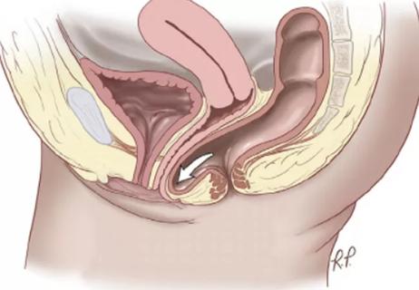 19-OBG-1028_CQD_650x450_Posterior-compartment-prolapse&#8211;rectocele