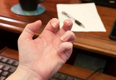 20-NEU-2023067 hand spasticity_650x450