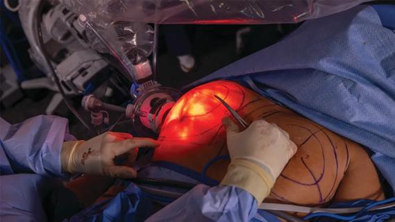 Robotic nipple-sparing mastectomy