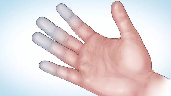 Medical illustration of hand with discolored fingers