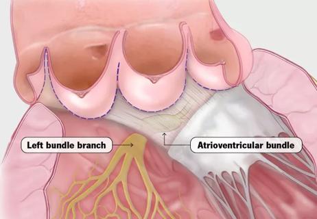 21-HVI-2061014_left-bundle-branch-atrioventircular-bundle_650x450